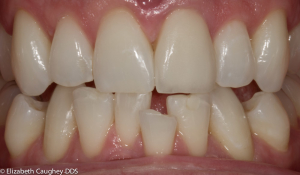 Braces and Resin Bonding - Elizabeth Caughey DDSElizabeth Caughey DDS