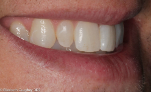 Braces and Resin Bonding - Elizabeth Caughey DDSElizabeth Caughey DDS