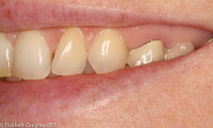 Keep those fragments! Easy tooth repair after 'break-fast - Elizabeth  Caughey DDSElizabeth Caughey DDS
