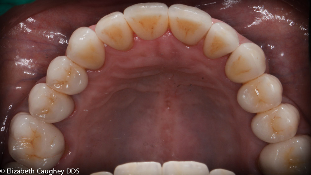 Braces and Resin Bonding - Elizabeth Caughey DDSElizabeth Caughey DDS