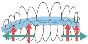 Braces and Resin Bonding - Elizabeth Caughey DDSElizabeth Caughey DDS