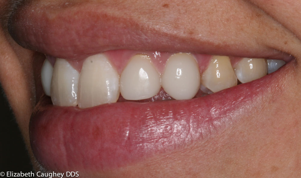 Braces and Resin Bonding - Elizabeth Caughey DDSElizabeth Caughey DDS