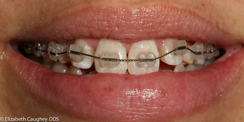 Mid-treatment, Front: Braces and bonding for congenitally missing teeth - Elizabeth  Caughey DDSElizabeth Caughey DDS