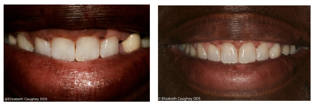 Braces and Resin Bonding - Elizabeth Caughey DDSElizabeth Caughey DDS