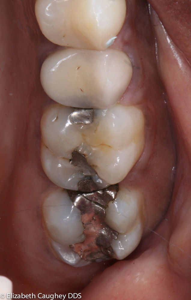 Pre-treatment photo- fractured amalgam and leaking filling and crown ...