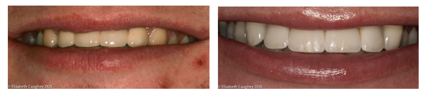 Keep those fragments! Easy tooth repair after 'break-fast - Elizabeth  Caughey DDSElizabeth Caughey DDS