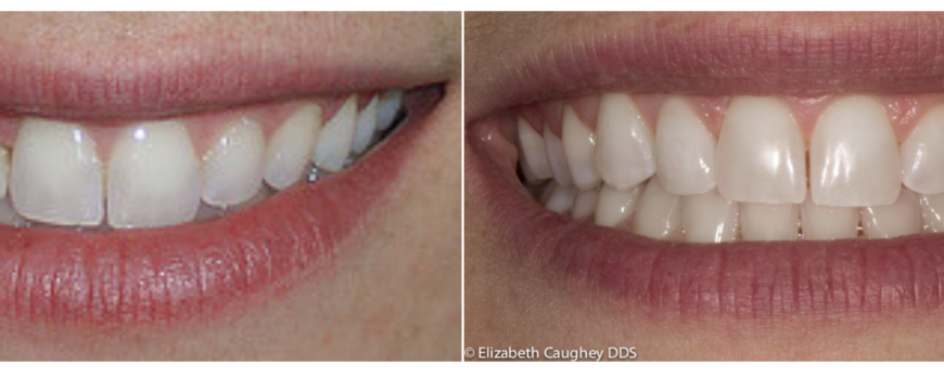 Braces and Resin Bonding - Elizabeth Caughey DDSElizabeth Caughey DDS