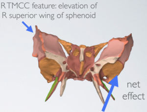 Sphenoid position is altered by torque from L mandibular contact.