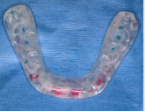 This bite splint has been adjusted to create a slightly earlier contact across the Left posterior teeth.