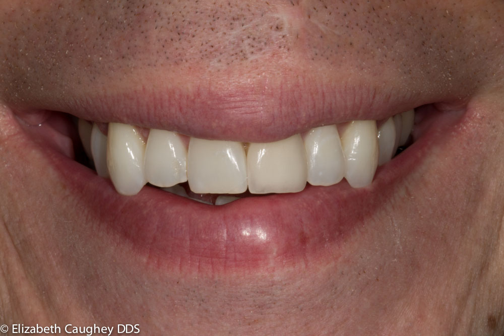 single feldspathic porcelain veneer strengthens tooth