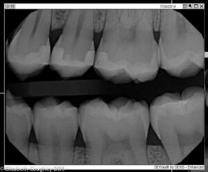 After X-ray new interproximal direct restorations-2