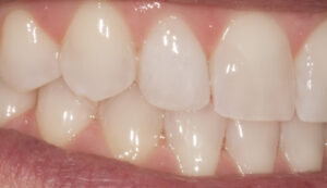 After: porcelain veneer on lateral incisor (zoomed)