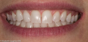 After: porcelain veneer on lateral incisor