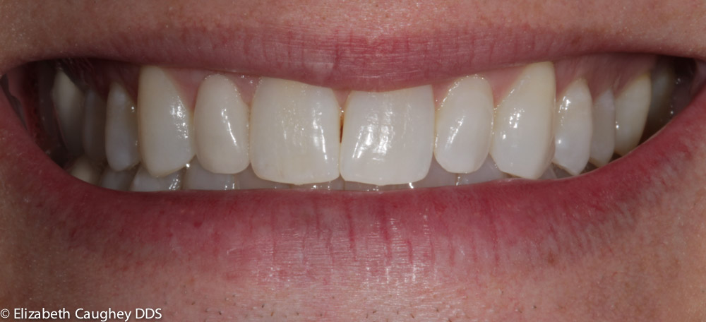 single porcelain veneer atlanta