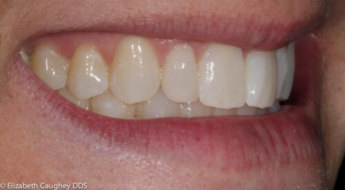 After: peg lateral incisor on patient's right (side view).