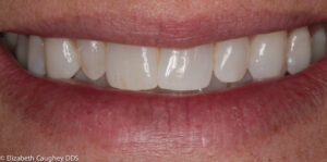 Before: peg lateral incisor on patient's right (front view).