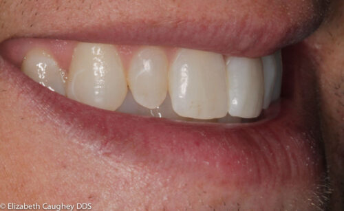 Before: peg lateral incisor on patient's right (side view).
