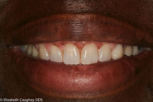 Final dentistry in place: new porcelain crowns with ideal color match, lifted gums, and overall aesthetic balance.