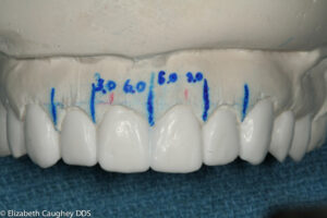 A second set of models is modified with wax to plan for the final tooth position.