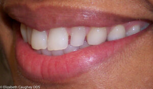 Before smile of small upper teeth and spaces, Side view.