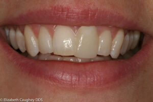 Before image: upper left central incisor had been previously restored with monochromatic, oversized porcelain veneer.