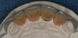 Lab view of 4 custom porcelain crowns, Occlusal view.
