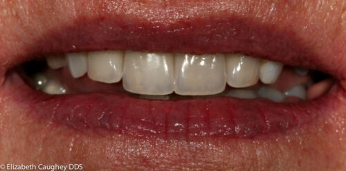 Atlanta reconstructive comprehensive dentistry using dental implant and all-ceramic crowns