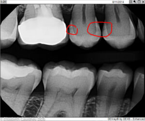 Contrast change on digital X-ray reveals decay