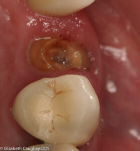 Fractured post and crown: intra-oral view.