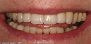 After photo: Porcelain crowns and implant-crown