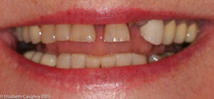 Before photo: Porcelain crowns and implant-crown.