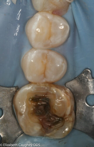 Removal of deepest amalgam shows black-brown decay close to the pulp (nerve chamber) of the tooth.