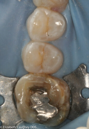 Initial amalgam removal, having stopped at the point deepest within the tooth.