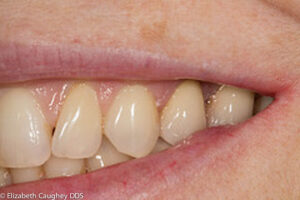 Post-treatment photo: dental implant to replace missing permanent tooth.