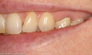 Pre-treatment photo: bridge to replace missing permanent tooth. Note short gum height.