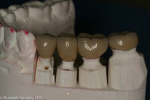Lab view: new implant crowns with broad contacts to prevent food entrapment.