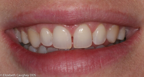 spaces and malocclusion before comprehensive management with TMJ care, orthodontics, and veneers