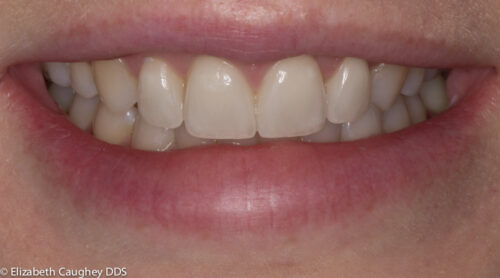 porcelain veneers after TMJ and orthodontics