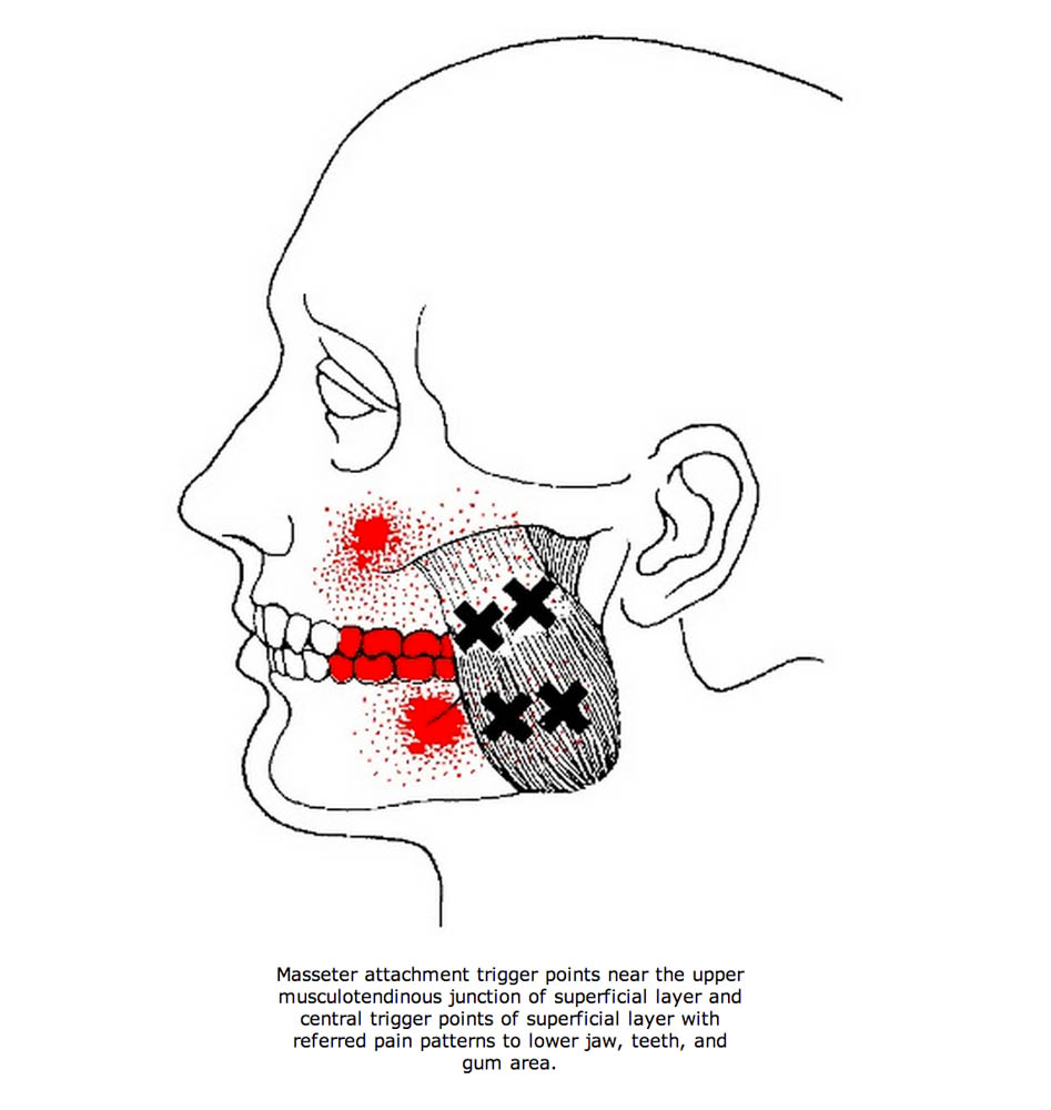 Travell-Simons pain referral pattern for masseters to molars.