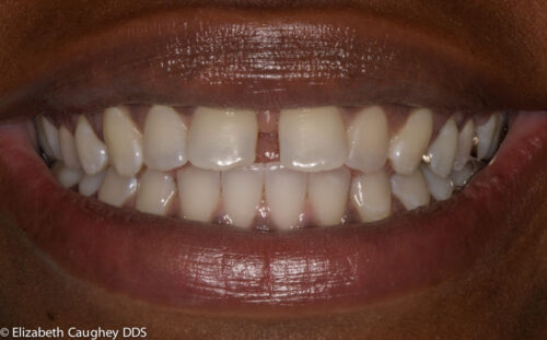 Control of shape of restorations results in minimal gold display within smile.