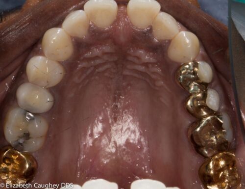 Occlusal view of gold chewing surfaces on patient's Left.