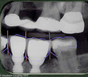 Radiograph showing asymmetrical contours between implant crowns and adjacent teeth. Lower left.