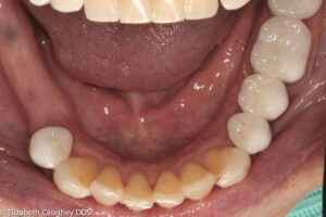 Teeth removed to prevent infection through bone.