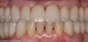 Post-treatment photo: matched set of custom crafted all-ceramic crowns and bridge.