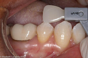 Pre-treatment photo: molar crown with leaking margin. Shade tab of translucent enamel layer.