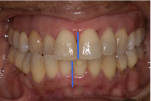 Uncorrected, the cross-bite appears unilateral. This is due to a functional shift of the lower jaw.