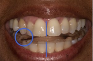 After splint releases posturing, unilateral cross-bite now appears as bilateral end-to-end bite at canines & posterior teeth.