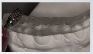 With both buccal and lingual cusps of upper teeth making an indentation in splint, either cusp could be utilized for supporting posterior contact.