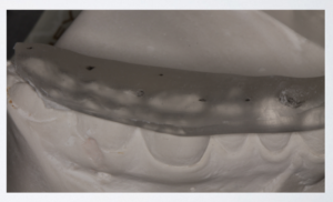 Splint refined at fabrication, using lingual cusps at the molars, and accepting buccal cusp at the premolar where the "bite crosses"
