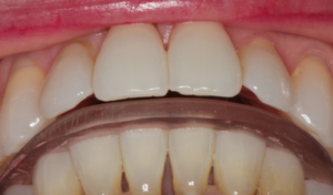 Freedom of anterior tooth contact at splint delivery appointment